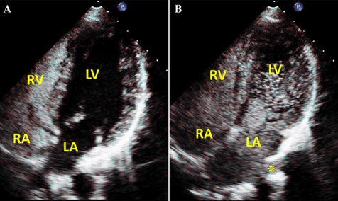 Saline Contrast Echocardiography in the Era of Multimodality  Imaging—Importance of “Bubbling It Right” - Gupta - 2015 - Echocardiography  - Wiley Online Library