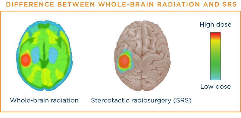 Radiation Therapy | LUNGevity Foundation
