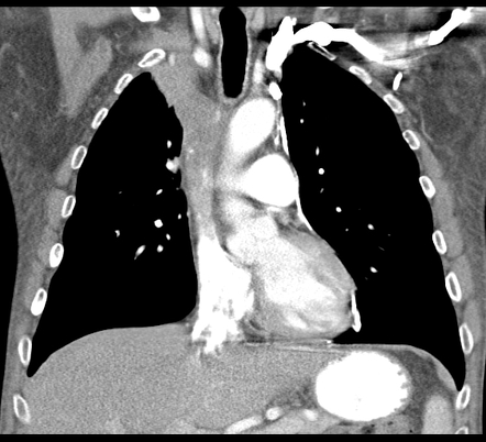 Superior vena cava obstruction | Radiology Reference Article | Radiopaedia.org