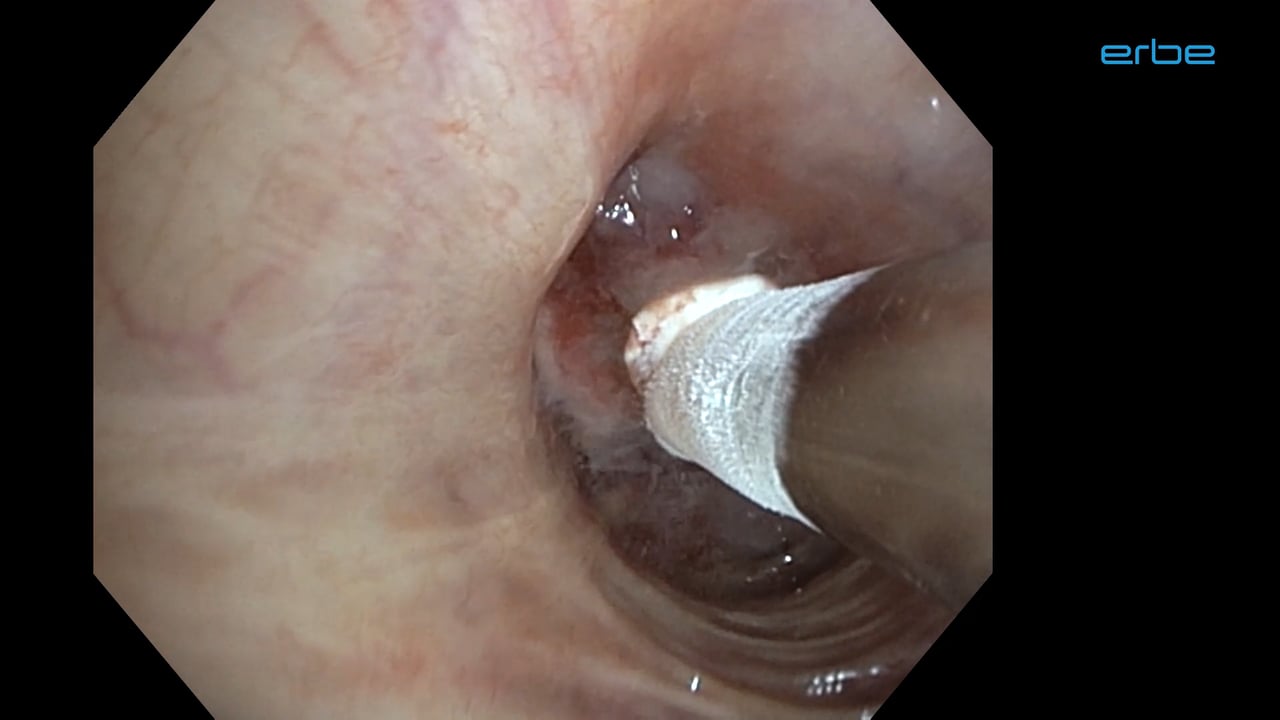 Cryobiopsy with ERBECRYO® 2 - Medical Videos